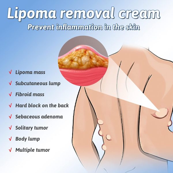 LIPOMA REMOVAL SPRAY ~লিপোমা রিমোভাল স্প্রে(১ পিস) - Image 3